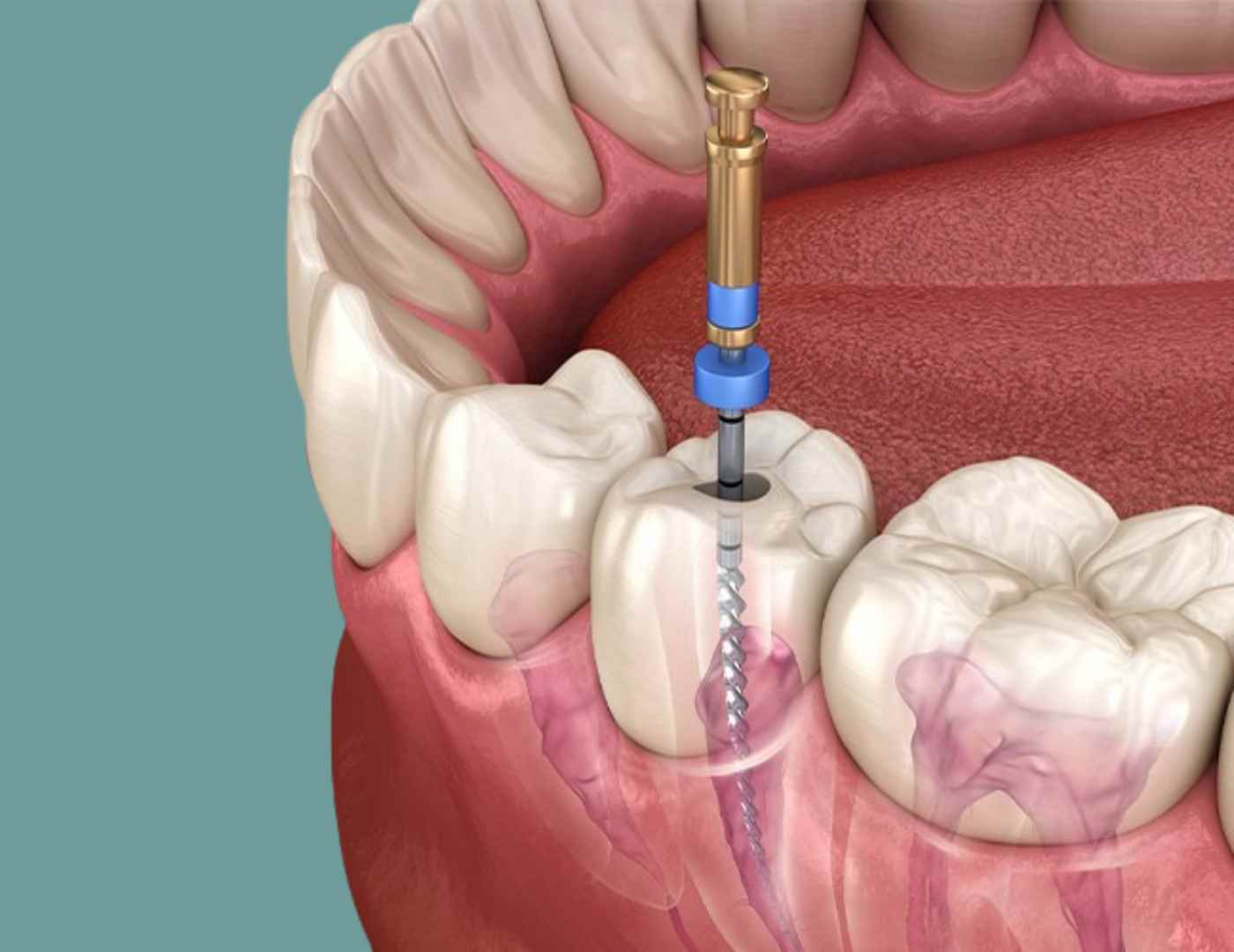 كيف يتم حشو العصب؟